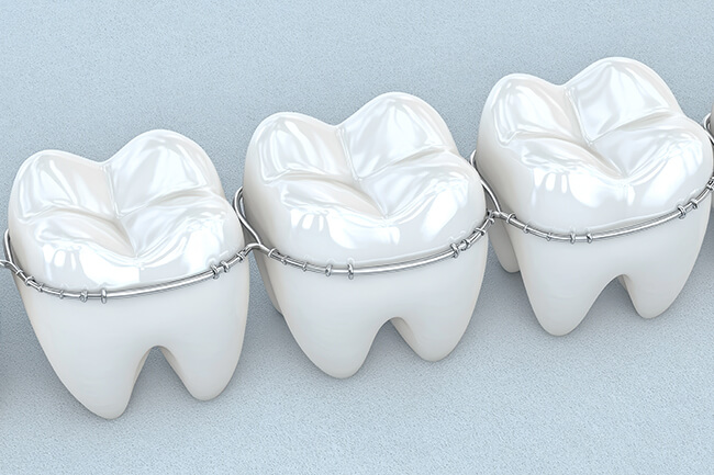 固定式ワイヤー装置