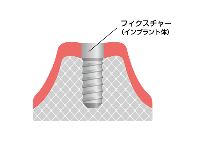 インプラント体(人工歯根)