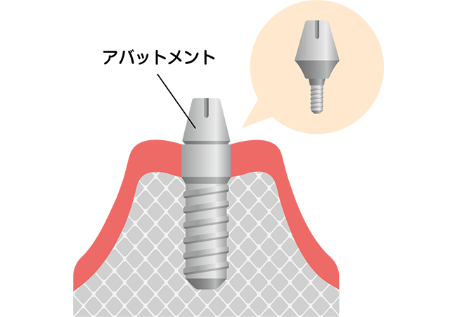 アバットメント