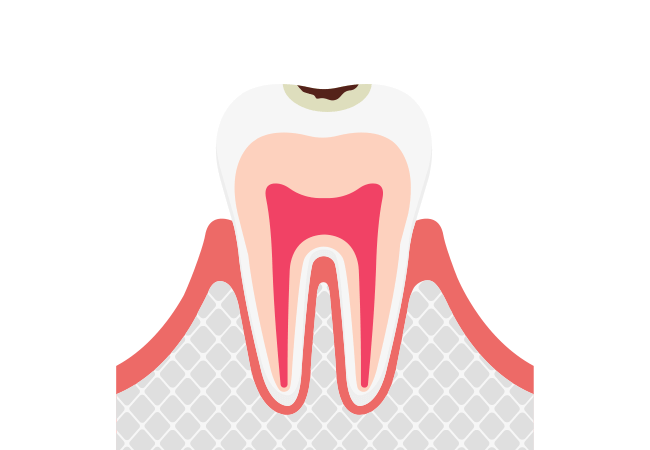 C1:エナメル質に小さな穴が空いた虫歯