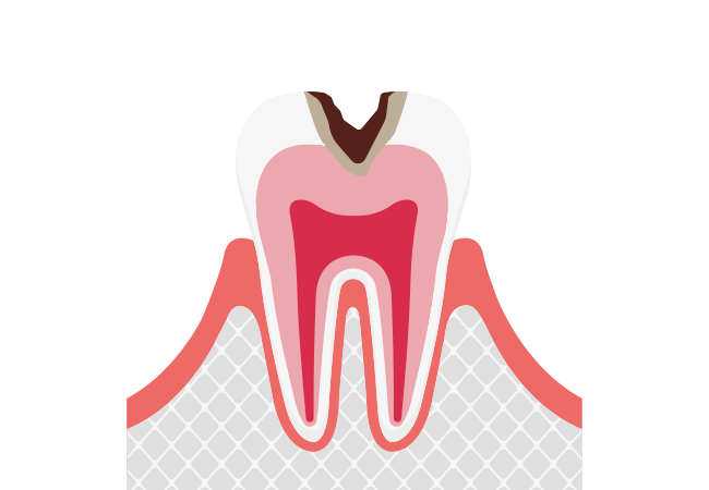 C2:歯の内部(象牙質)まで進行した虫歯