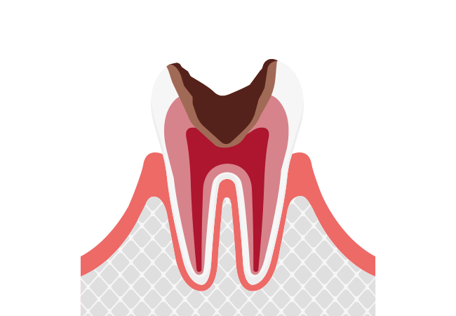 C3:神経まで進行した虫歯