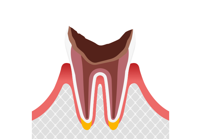 C4:歯根まで進行した虫歯