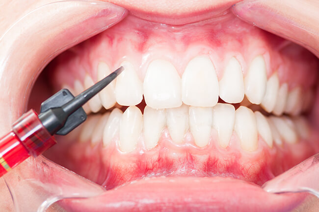 当院のホワイトニングの特長