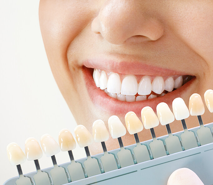 ホワイトニング