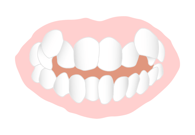 叢生(そうせい)