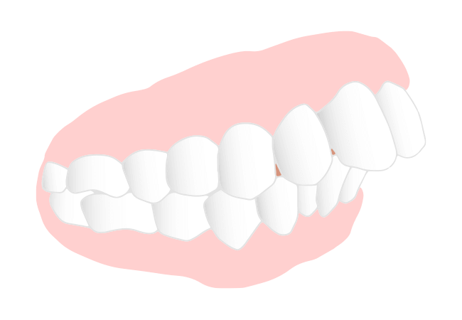 上顎前突(じょうがくぜんとつ)