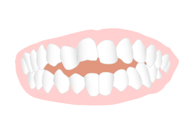 開咬(かいこう)