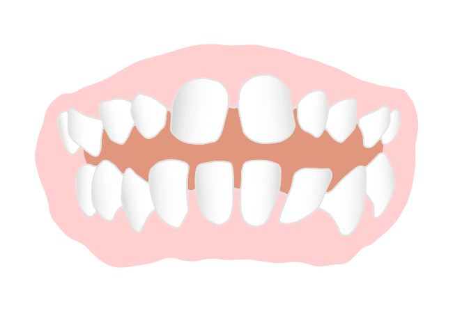 空隙歯列(くうげきしれつ)