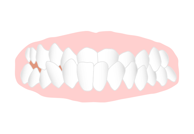過蓋咬合(かがいこうごう)